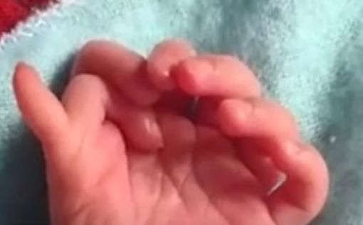 Редкое явление: девочка родилась с 26-ю пальцами